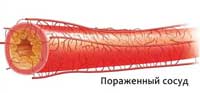 атеросклероз